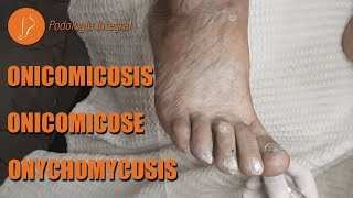 Fungus  Onychomycosis podology asmr [upl. by Ahgiela]