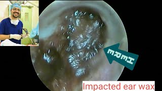 ear wax removal using suction and probe [upl. by Okoyk]