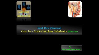 Ultrasound Case 14  Acute Calculous Sialadenitis Web case [upl. by Ellevel747]