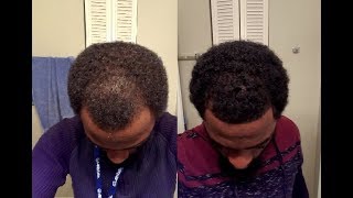 Rogaine Minoxidil Journey  Week 10 [upl. by Sorensen]