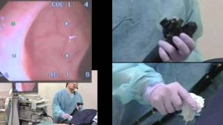 Colonoscopy  consecutive cases 120 [upl. by Lawley]