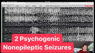 EEG of 2 Psychogenic Nonepileptic Seizures PNES [upl. by Sukhum]