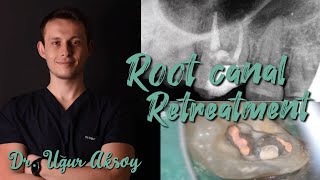 Root canal retreatment procedure Dr Uğur Aksoy [upl. by Alrrats]