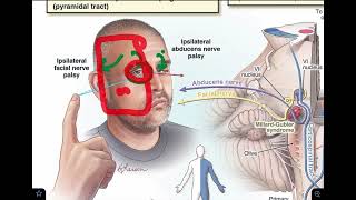 Millard Gubler syndrome  Ventral pontine syndrome  made super easy [upl. by Ellahcim]