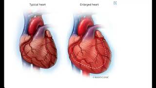 Cardiomegaly Video Lecture [upl. by Collbaith]