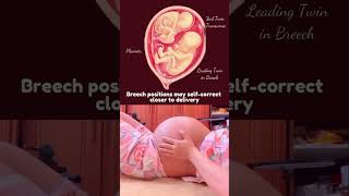 Breech baby in twin pregnancy pregnancy ultrasound motherhood [upl. by Korenblat397]