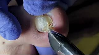 Ingrown Toenail Removal  Pedicure Treatment and Very Satisfying  Best Satisfying Nail Cutting [upl. by Binky998]