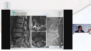 Evolution of Prone Lateral Interbody Fusion by Dr Muhammad AbdElBarr [upl. by Josefa]