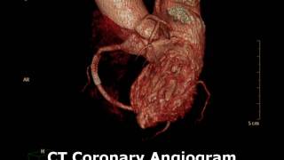 MDI Radiology CT Coronary Angiogram 3D [upl. by Ziwot264]