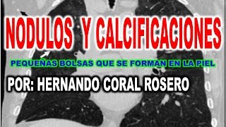 NODULOS Y CALCIFICACIONES PROSTÁTICO [upl. by Valda]