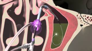 Balloon Sinuplasty Animation of the Maxillary Sinus  Seattle Sinus Surgeon [upl. by Ttiwed]