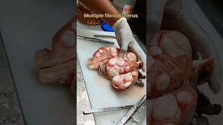 Multiple fibroid uterus specimen [upl. by Naneek946]