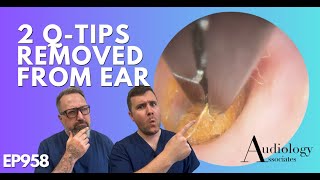 2 QTIPS REMOVED FROM EAR  EP958 [upl. by Ymor]