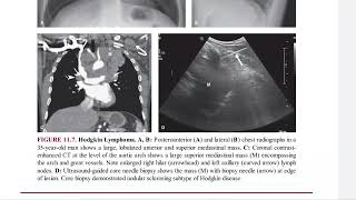 CHEST RADIOLOGY FUNDAMENTALS [upl. by Olivier]