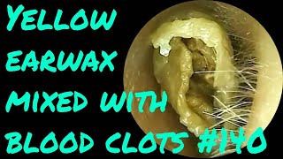 Yellow earwax mixed with blood clots 140 [upl. by Chisholm]