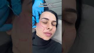 Subcision for ACNE SCARRING  Doctor Treatment [upl. by Nosbig]