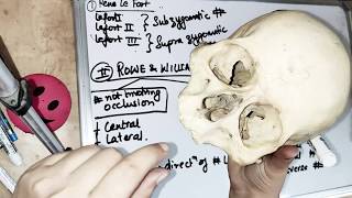 midfacial fractures  intro and classification [upl. by Semyaj]