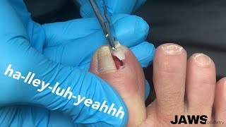 REMOVING A LARGE INGROWN TOENAIL [upl. by Sibby]