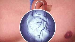 Coronary angioplasty [upl. by Karr]