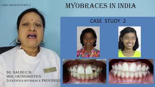 Myobrace case presentation 2 [upl. by Jahdai]