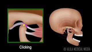 Temporomandibular Joint TMJ Anatomy and Disc Displacement Animation [upl. by Okuy]