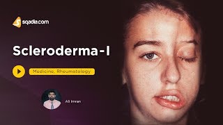 Scleroderma I  Rheumatology Medicine Video  Medical Student  VLearning  sqadiacom [upl. by Yellat]