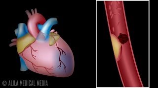 Myocardial Infarction and Coronary Angioplasty Treatment Animation [upl. by Karrie954]