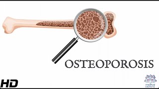 Osteoporosis Everything You Need To Know [upl. by Acisset474]