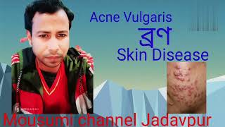 Acne vulgaris of skin disease [upl. by Codee212]