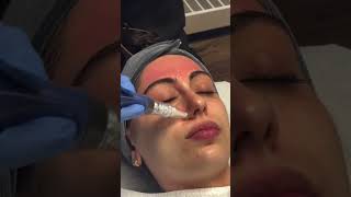 Have you Tried Microneedling with PRP Also Known as the Vampire Facial microneedling facial [upl. by Rose574]