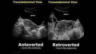 Uterine Positions In Ultrasound  AntevertedRetroverted  AnteflexedRetroflexed Uterus [upl. by Ait]