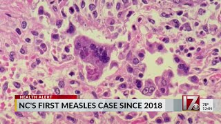 First measles case reported in NC since 2018 [upl. by Quinton855]