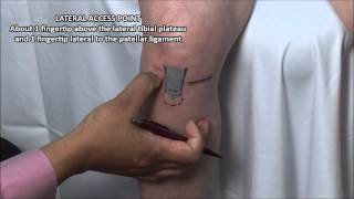 Knee Injection  Anterior Approach [upl. by Airla267]