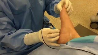 Radiofrequency Nerve Ablation for Heel Pain [upl. by Niahs]