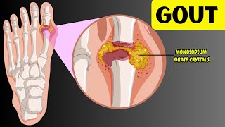 Understanding Gout  Causes Risk Factors Signs amp Symptoms Diagnosis amp Treatment [upl. by Salocin]