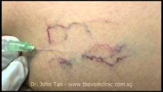 Injection Sclerotherapy [upl. by Silloh763]