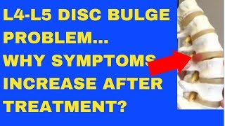 Why Does L4 L5 Disc Bulge Symptom Increase After Treatment  Answered by Chiropractor in Vaughan [upl. by Naux]