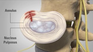 Patient Animation  Lumbar Degenerative Disc Disease [upl. by Sseb]