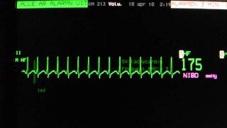 AV nodal reentry tachycardia AVNRT on an ECG heart monitor [upl. by Calisa]