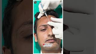 Unbelievable Skin Transformation After Subcision Treatment Awish clinic [upl. by Mailiw]