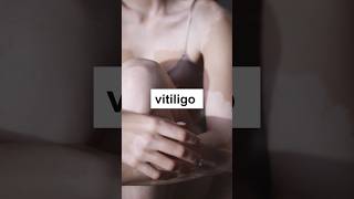 What is Vitiligo and how to stop it Get to know everything with Skinaa Clinic shorts viral [upl. by Nacim701]