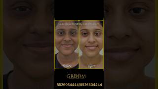 Skin Lightening Treatment Transformation [upl. by Leen698]