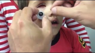 NIÑO QUE SUFRIÓ ACCIDENTE PUEDE VERSE SU OJO COMPLETO GRACIAS A UNA PRÓTESIS [upl. by Rabbi883]