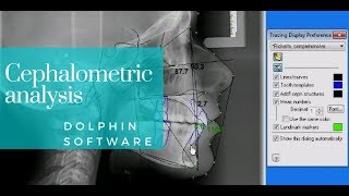 Dolphin cephalometric analysis  Orthodontic Matters Episode 16 [upl. by Berna]