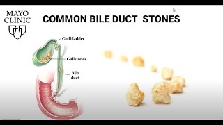 Laparoscopic Transcystic Common Bile Duct Exploration [upl. by Bette-Ann]