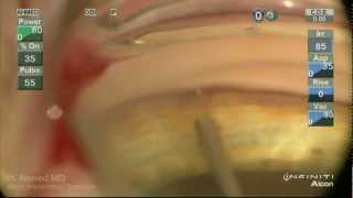 iStent Trabecular MicroBypass Implantation Ike Ahmed [upl. by Eillat]