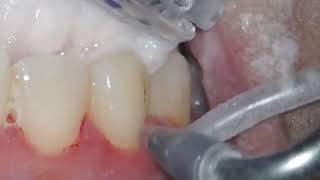 Airflow Dental Cleaning Testimonials  Oxley Comprehensive Dentistry [upl. by Anolahs218]