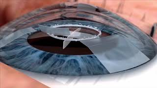 Watch live surgery using the laser cataract system  how does it work Eye News TV [upl. by Haidebez]