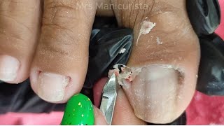 Toenail Ingrown RemovalMaraming nakatagong Dry Skinpart 2 [upl. by Norha849]