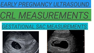 Pregnancy ultrasound showing CRL GESTATIONAL SAC MEASUREMENTS Early Pregnancy ultrasoundyoutube [upl. by Baese838]